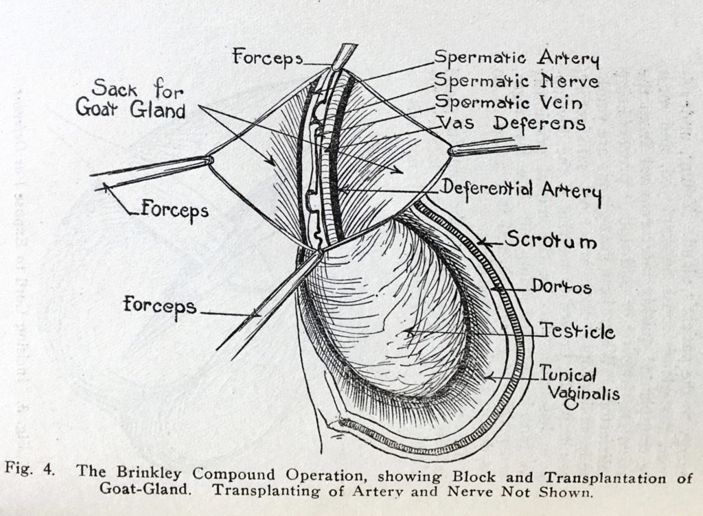 Brinkley Goat Gland Operation